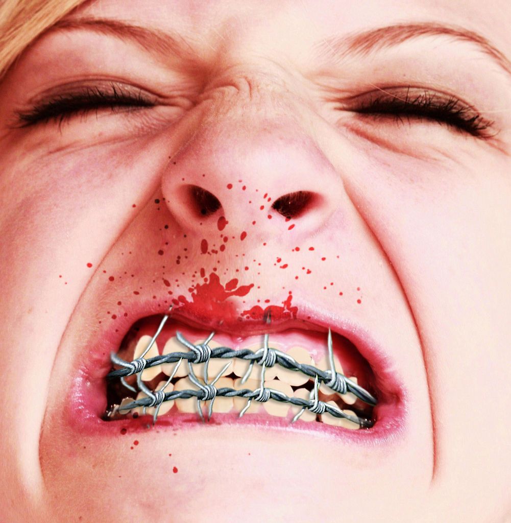 deepthroat Teen braces